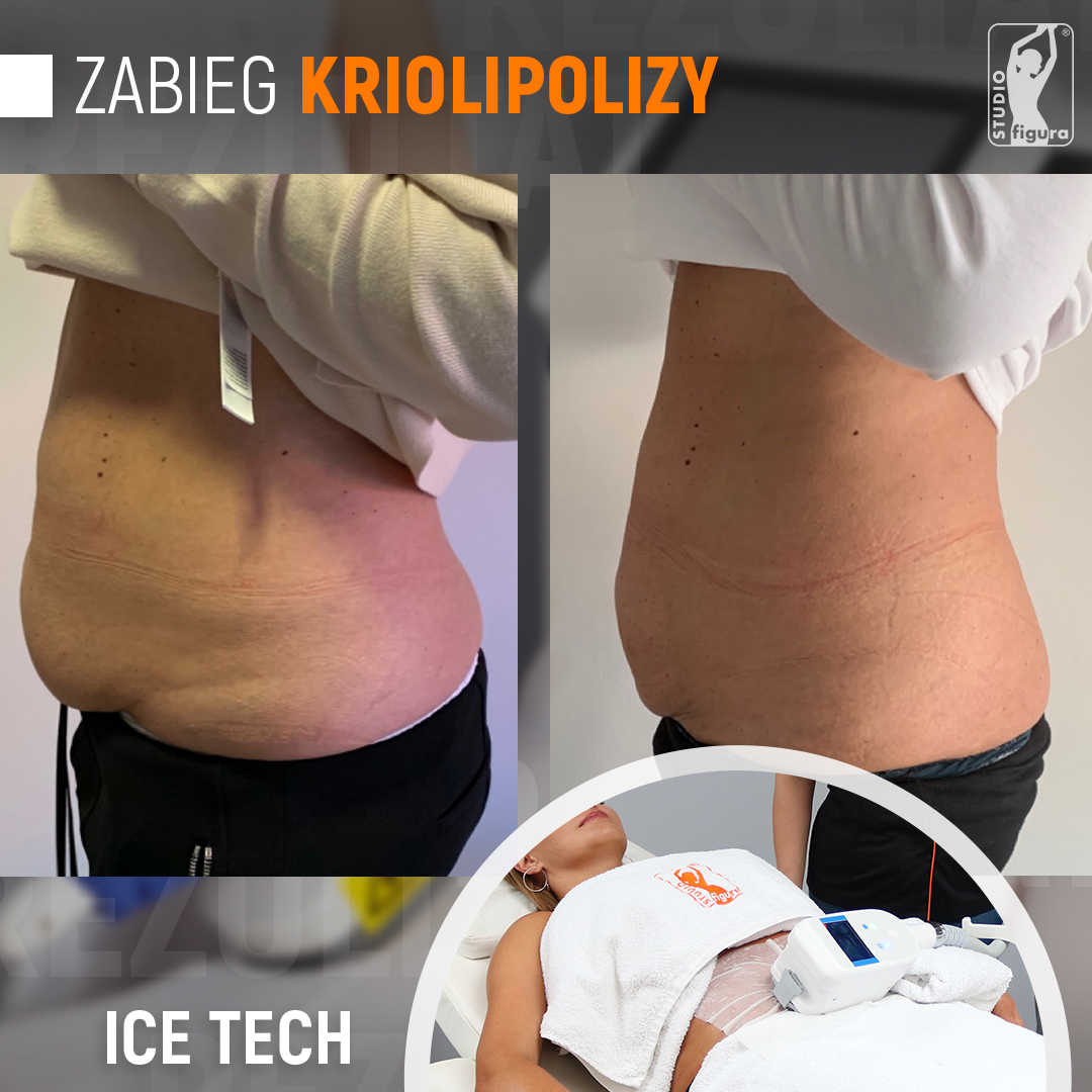 Rezultat klientki po zabiegu kriolipolizy